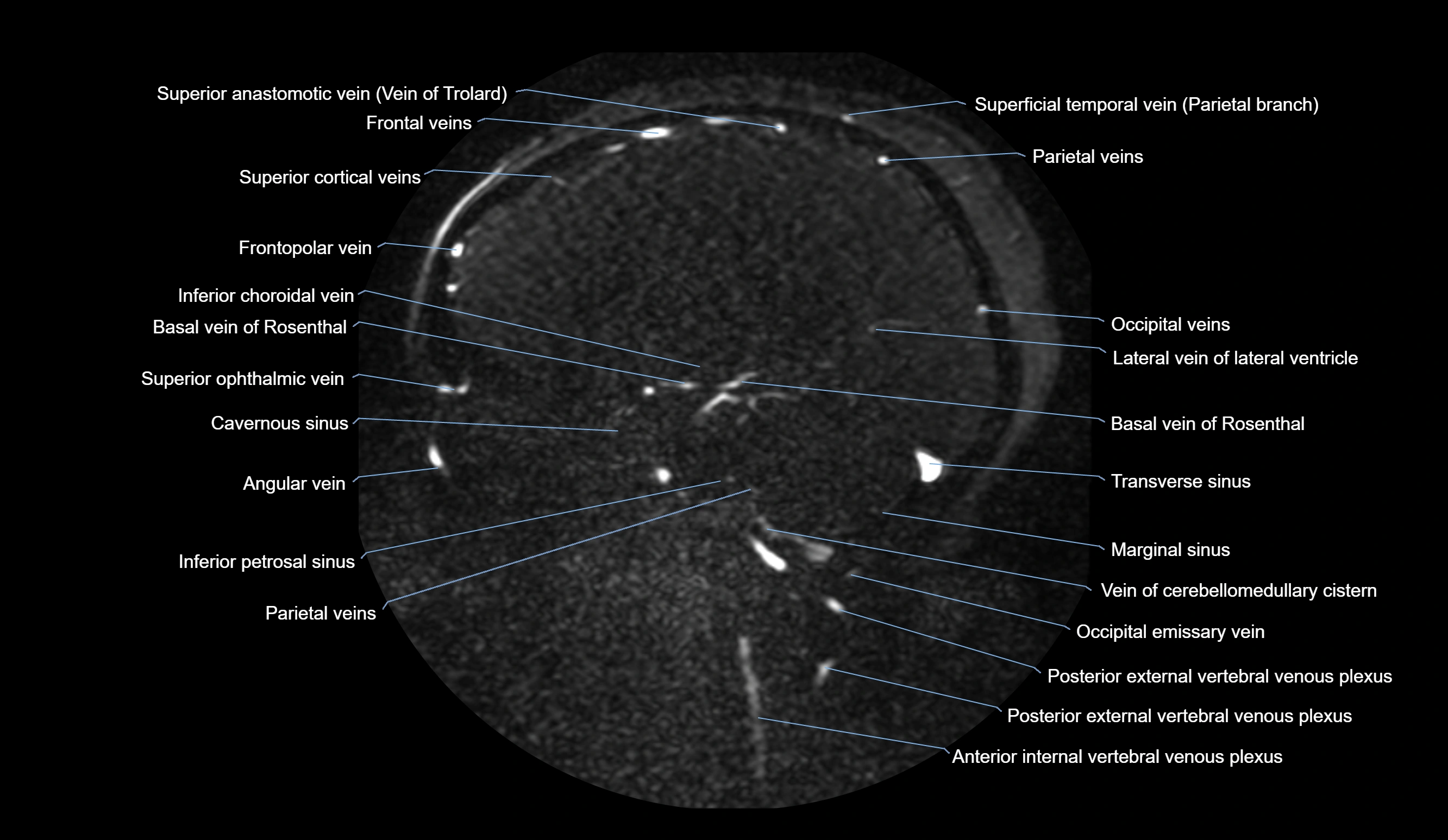 MRV brain sagittal anatomy 3T MRI images -img-01015-00035.webp